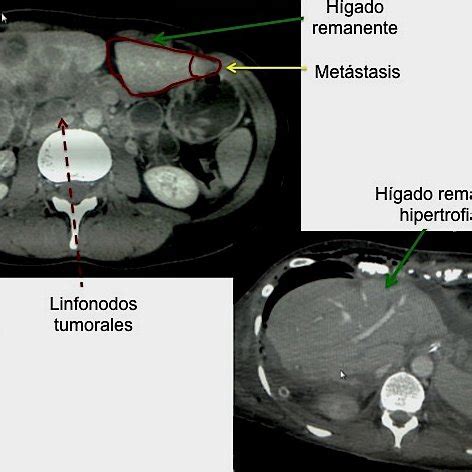 Visión intraoperatoria de un hígado metastásico con origen en un cáncer