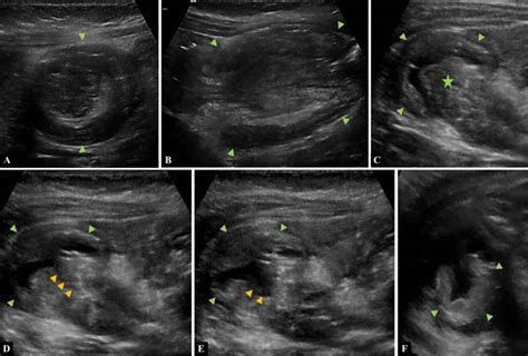 Case Of A 9 Month Old Infant With Abdominal Distension And Currant Download Scientific Diagram