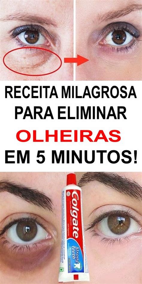 Receita Simples Para Eliminar As Olheiras Em 2020 Tratamentos De