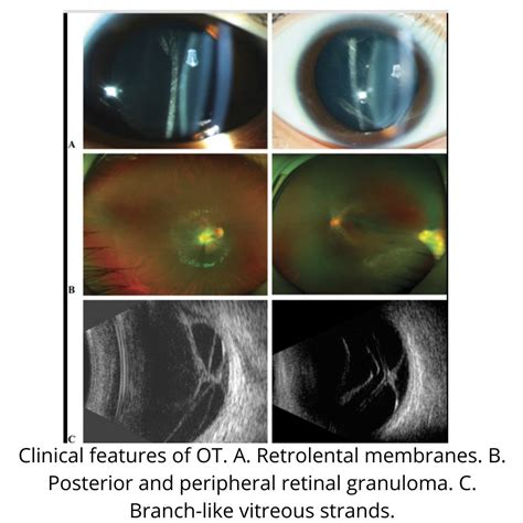 Toxocariasis Retina