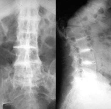 Ochronosis - Basic Science - Orthobullets