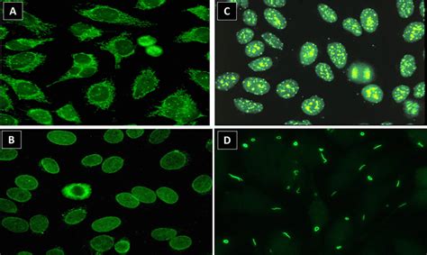 Hep 2 Indirect Immunofluorescence Assay Hep 2 Ifa Patterns Associated