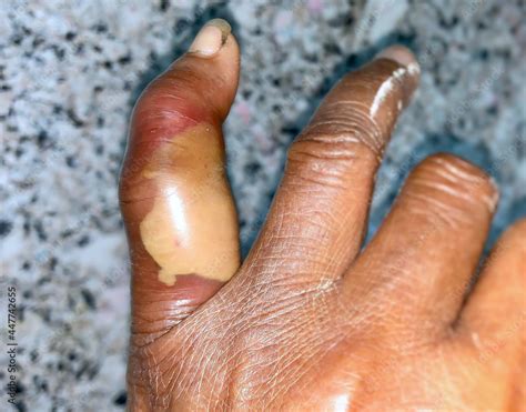 Abscess With Surrounding Cellulitis Or Staphylococcal Streptococcal Skin Infection At Finger