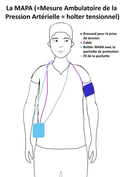 Holter tensionnel ou MAPA ICPC centres de cardiologie à Paris et