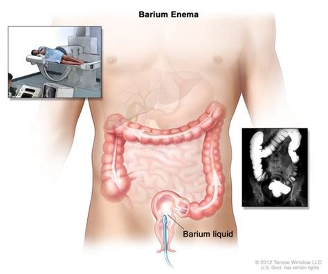 Definition Of Barium Enema Nci Dictionary Of Cancer Terms Nci