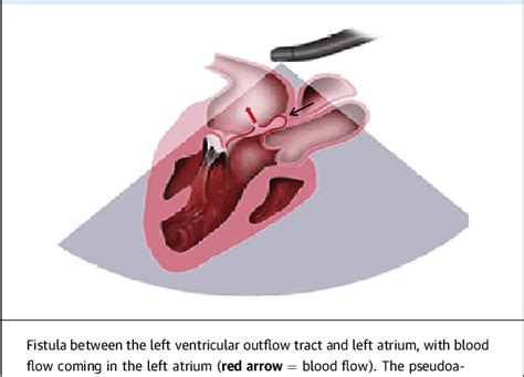 Figure 1 From Mitral Aortic Intervalvular Fibrosa Semantic Scholar