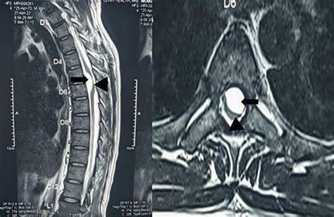 Thoracic Spinal Intradural Arachnoid Cyst With A Fulminant Course