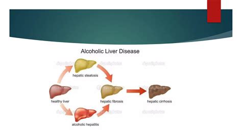 Case Presentation On Alcoholic Liver Disease Ppt