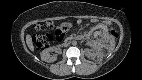 Hemorrhagic Renal Angiomyolipoma In A Tuberous Sclerosis Phakomatosis Patient Youtube