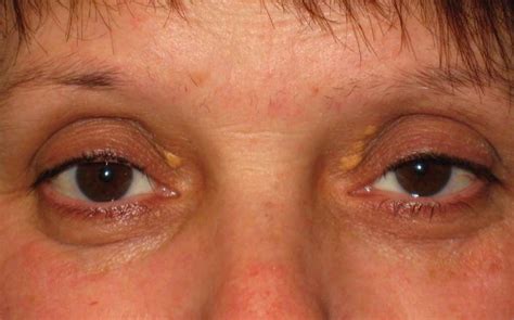 Yellow Eyelids Xanthelasma High Resolution Pictures And