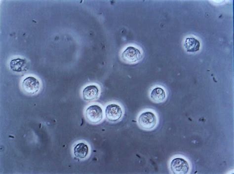 What Is Urosepsis - Klarity Health Library