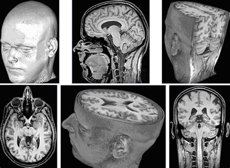 Mri Scan Brain 3d