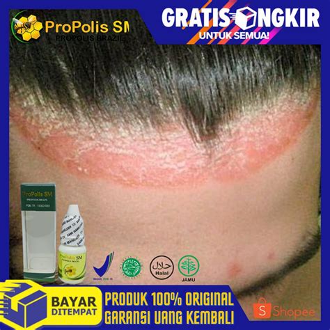 Jual Obat Psoriasis Kulit Kepala Kulit Kepala Bersisik Kering