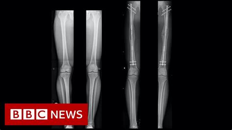 Leg Lengthening The People Having Surgery To Be A Bit Taller Bbc