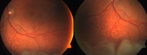 Bilateral Idiopathic Uveal Effusion Syndrome Iues Retina Associates