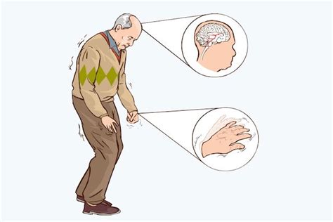 Quais Os Primeiros Sintomas Do Mal De Parkinson Tua Sa De