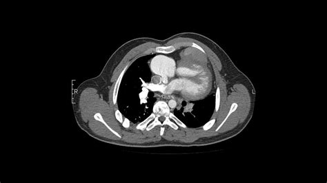 Tricuspid Atresia: Causes, Diagnosis, Treatment - StoryMD