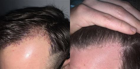 Failed Hair Transplant R Hairtransplants