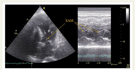 Echocardiography Of Left Ventricular Outflow Tract Obstruction With