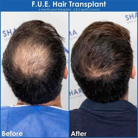 Crown Hair Transplant The Sharma Clinic