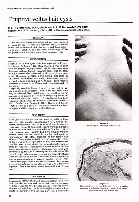 PDF Eruptive Vellus Hair Cysts