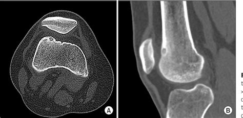 Figure 1 From Arthroscopic Excision Of An Intraarticular Osteoid