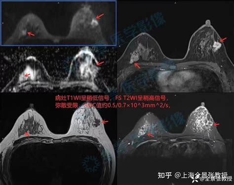 已经做了乳腺彩超和钼靶，为什么还要做乳腺磁共振？ 知乎