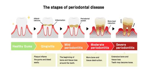 Periodontal (gum) Therapy Mississauga | Lakeshore Dental Center