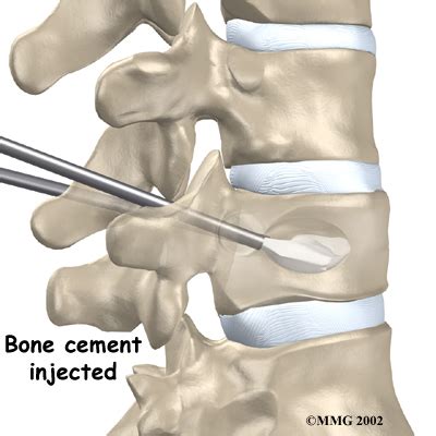 Vertebral Compression Fracture Surgery