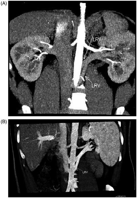 Mdct Angiogram In 25 Year Old Male Renal Donor With Two Retroaortic Download Scientific Diagram