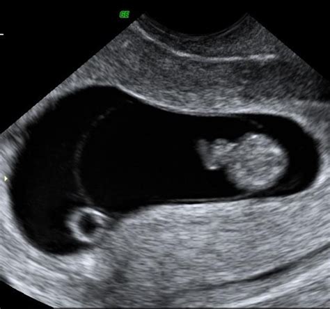 Yolk sac | Radiology Reference Article | Radiopaedia.org | Radiology, Diagnostic medical ...