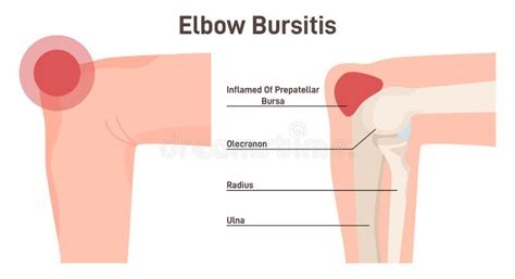 Bursitis Inflamación De La Articulación Del Codo Bursa Inflamada O