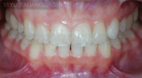 Post Orthodontic White Spot Lesions And Resin Infiltration The New Way