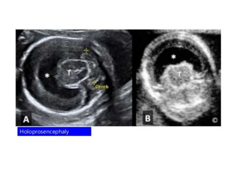 Fetal Anomaly Scan Ppt