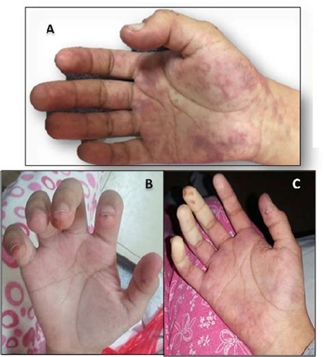 Livedo Reticularis Hands