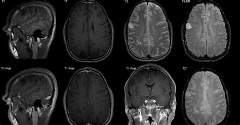 Roentgen Ray Reader: Low-Grade Astrocytoma