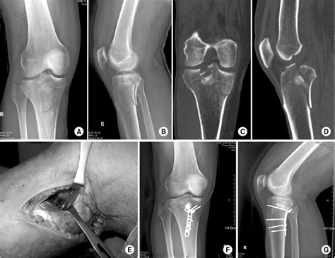 Tibial Plateau Fracture Ao Classification