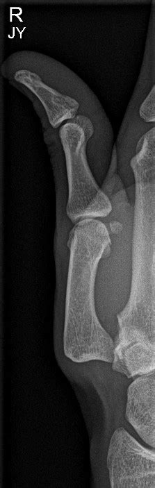 Dislocated First Carpometacarpal Joint Image Radiopaedia Org