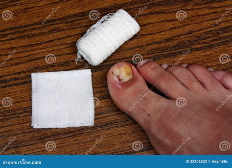 Treatment After The Removal Of Ingrown Toenail Stock Photos - Image ...