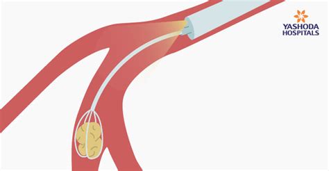 Sialendoscopy For Salivary Gland Diseases A Minimally Invasive