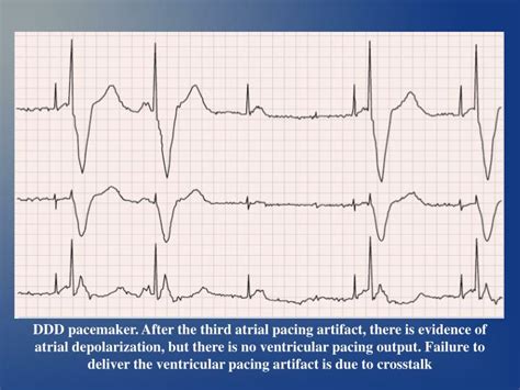 Ppt Pacemaker Malfunction Powerpoint Presentation Id5755499