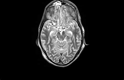 Brain injury, MRI scan Photograph by Science Photo Library