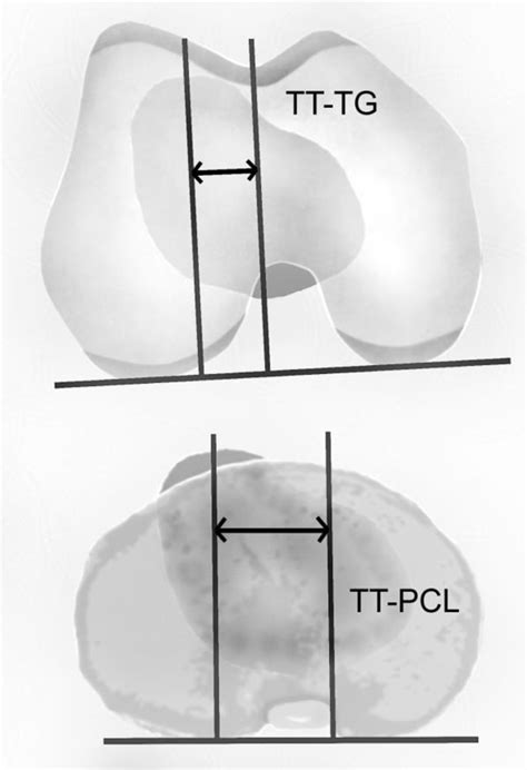 Upper Image Shows The Measurement Of The Tibial Tubercle Trochlear