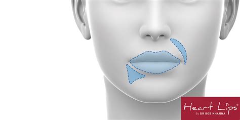 Advanced Lip Filler Techniques Dr Bob Khanna Training Institute