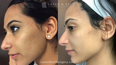 How To Treat Textured Skin According To Dermatologists Laser NY