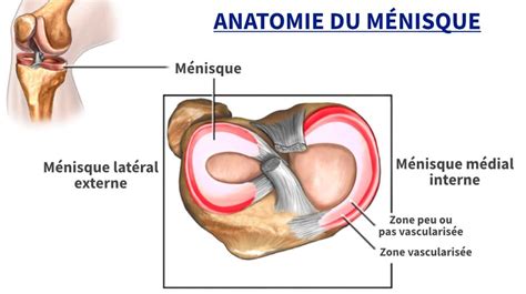 Fissure Du M Nisque Sur Irm Que Faire