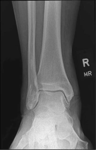 1 Month Postoperative Anteroposterior Ankle Radiograph Download