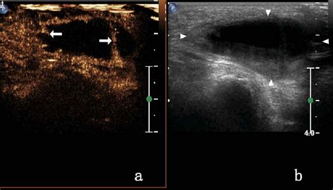 Figure From The Role Of Contrast Enhanced Ultrasound In The