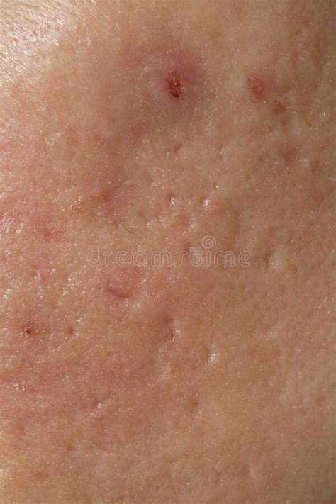 Texture Of Problematic Human Skin With Large Looking Open Pores And