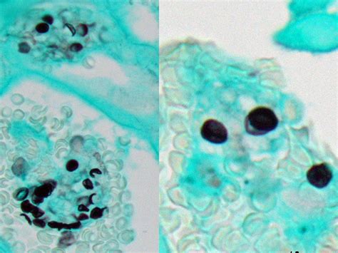 Pneumocystis Jirovecii Mycology University Of Adelaide